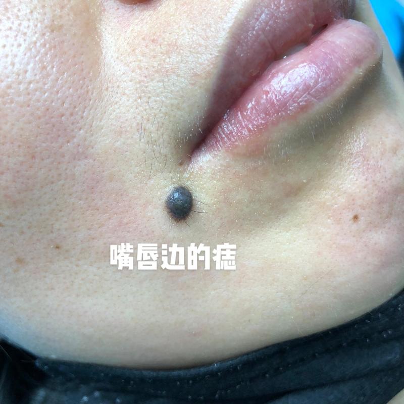 117731.cσm查询澳彩开奖号码和孙俪唇下痣没了与孙俪嘴唇的痣